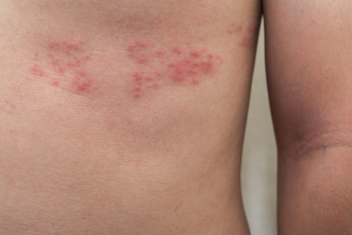 Red bumpy rash on a mans ribs.